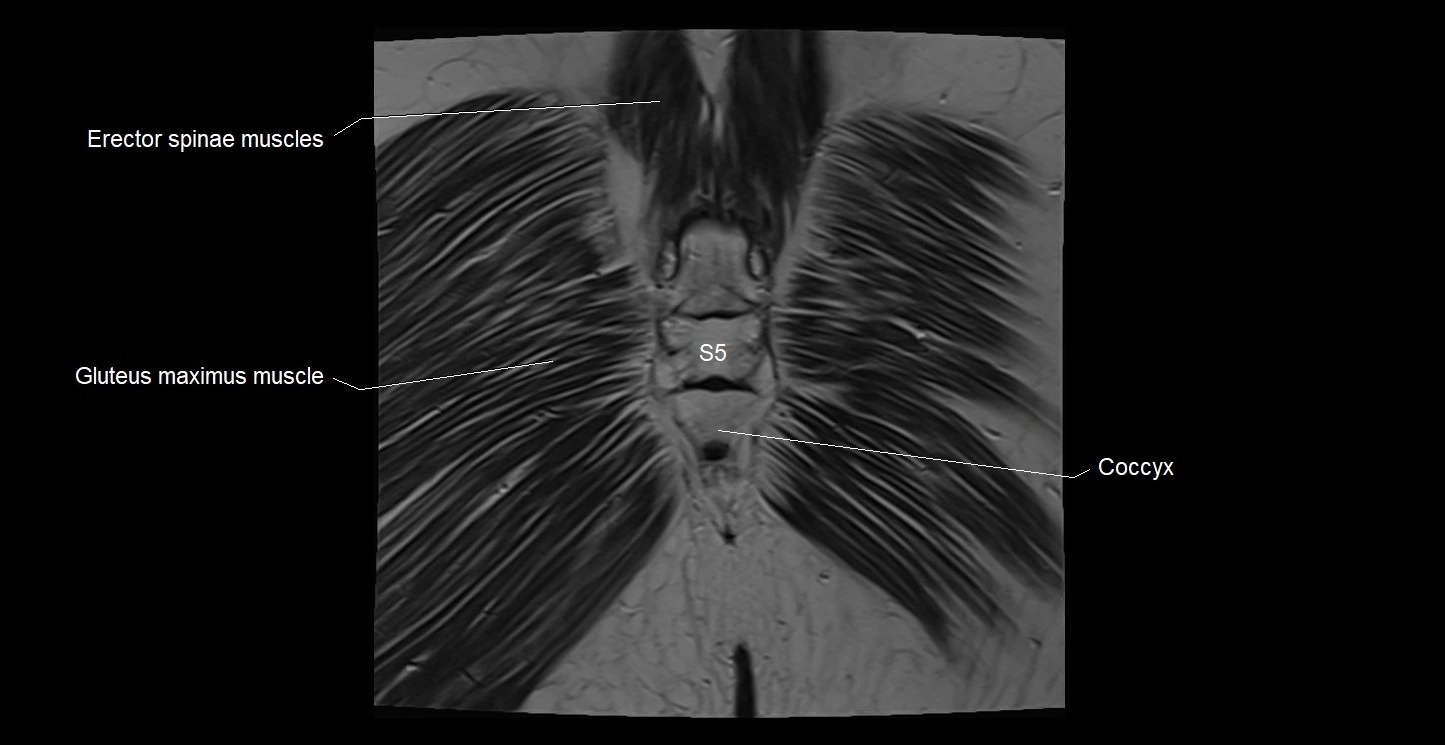 MRI coronal cross sectional anatomy male pelvis image 41.webp